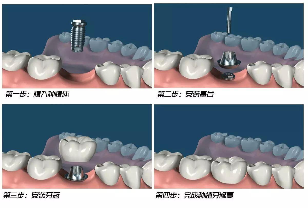 種植牙最新技術(shù)與發(fā)展趨勢(shì)分析概覽